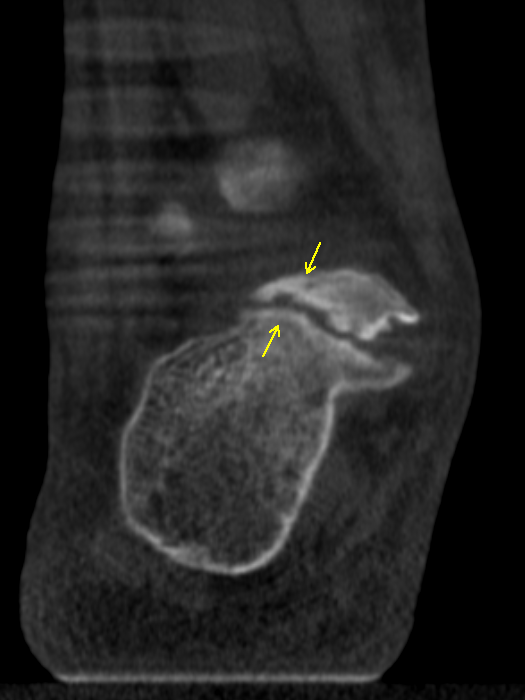 Case 1 AP and Oblique XRays